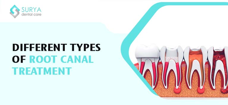 What are the different Types of Root Canal Treatment